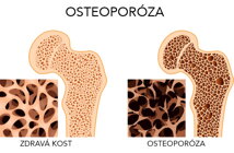 osteoporoza