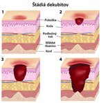 Mikroprúdy v liečbe dekubitov