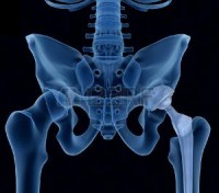 Endoprotézy kĺbov